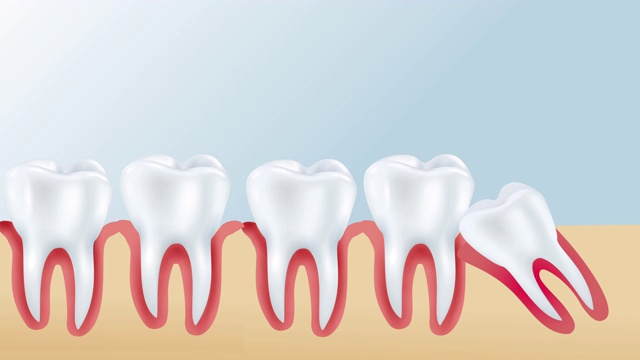 牙龈与智齿近中引起拥挤。智齿阻生引起的问题包括。视频素材