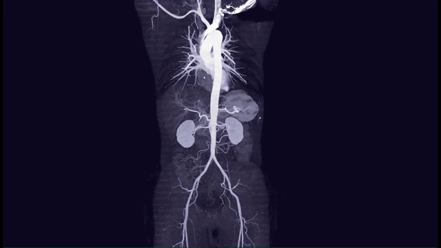 CTA全主动脉3D MIP视图。视频素材