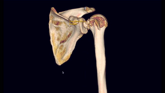 左肩CT扫描三维图像显示肱骨骨折头。视频素材