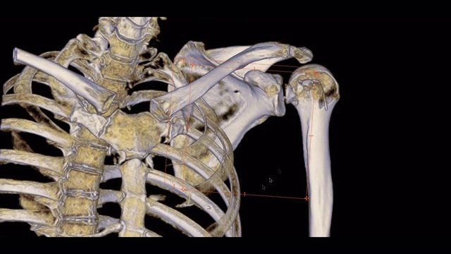 左肩CT扫描三维图像显示肱骨骨折头。视频素材