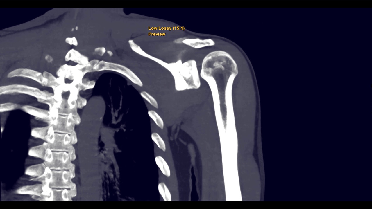 左肩冠状面CT扫描显示肱骨头骨折。视频素材