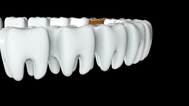 金牙排成一排洁白的牙齿。3 d渲染。牙科，挤出人群，经营理念视频素材