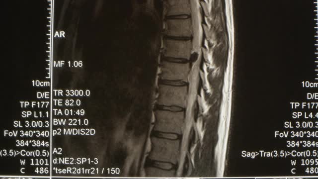 腰椎的矢状面磁共振图像或MRI显示破裂的椎间盘突出视频素材