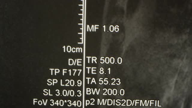 腰椎MRI矢状面微距拍摄视频素材