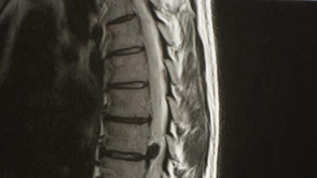 慢性腰痛患者的腰椎MRI检查显示腰骶棘退行性改变并椎间盘突出视频素材