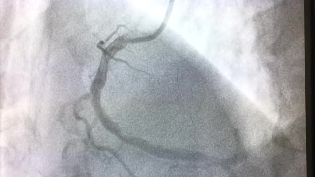 冠状动脉造影视频下载