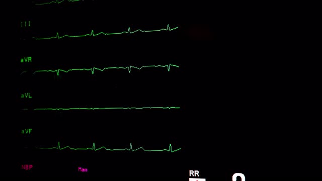心电图波形视频素材