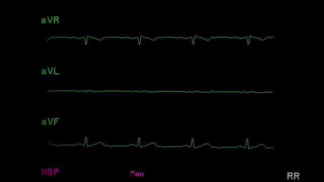 心电图视频素材