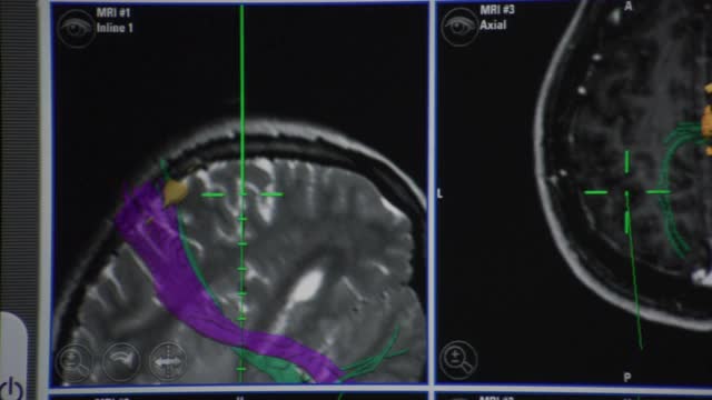 磁共振成像计算机图像以丰富的图形和技术信息说明一个人类脑瘤。视频素材