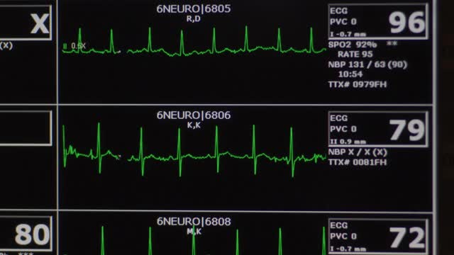 电脑心脏监测器屏幕显示了几个病人的心电图心率和医疗统计数据。视频素材