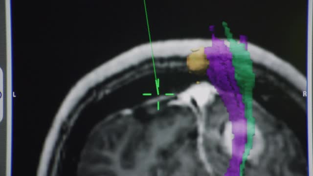 MRI计算机图像以彩色图形和技术信息说明人脑肿瘤;相机倾斜显示额外的场景。视频素材