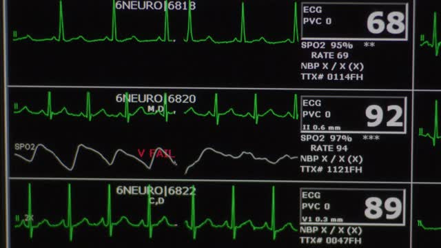 电脑心脏监测器屏幕显示了几个病人的心电图心率和医疗统计数据。视频素材