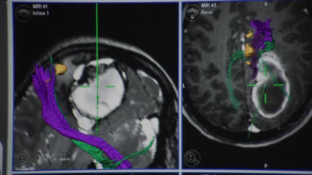 MRI计算机图像以彩色图形和技术信息说明人脑肿瘤;相机倾斜显示额外的场景。视频素材