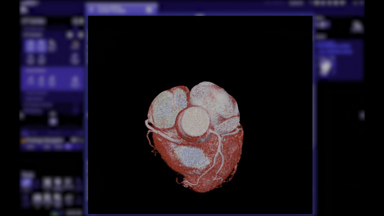CTA冠状动脉三维成像。视频素材