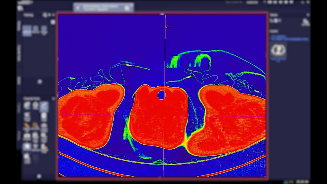 CT胸部造影剂轴位观。视频素材
