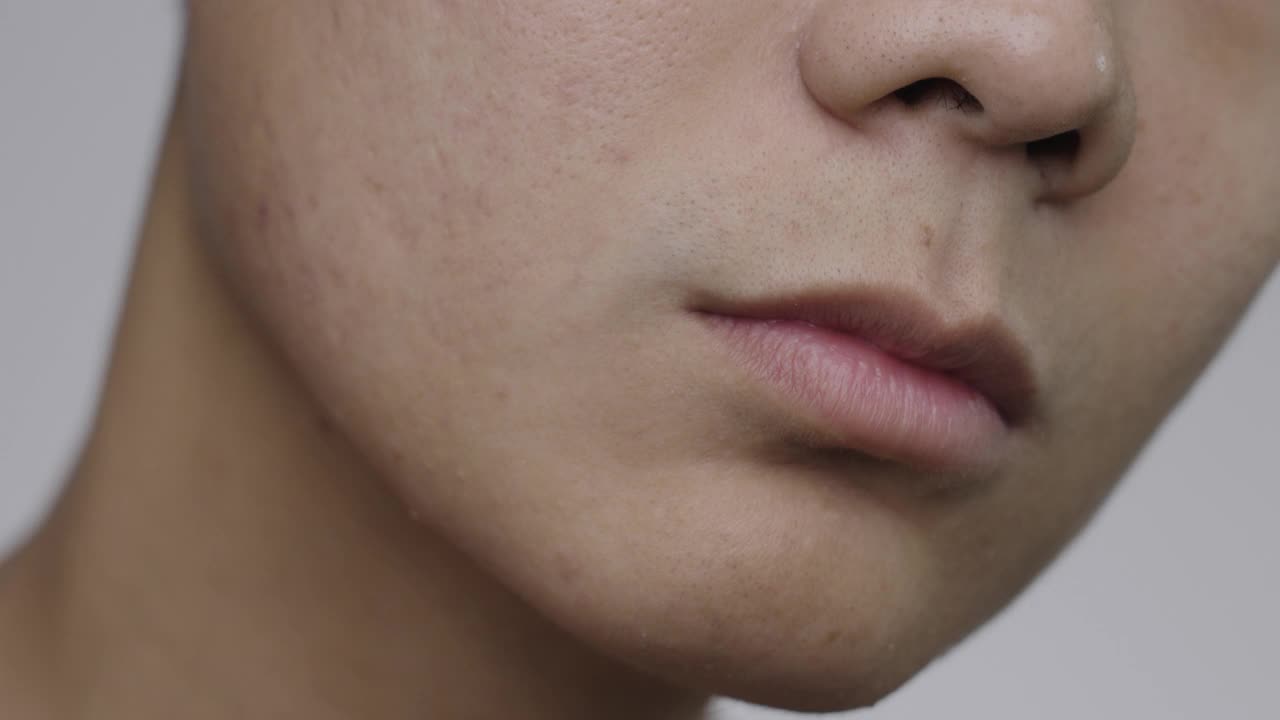 粉刺的脸皮肤视频素材