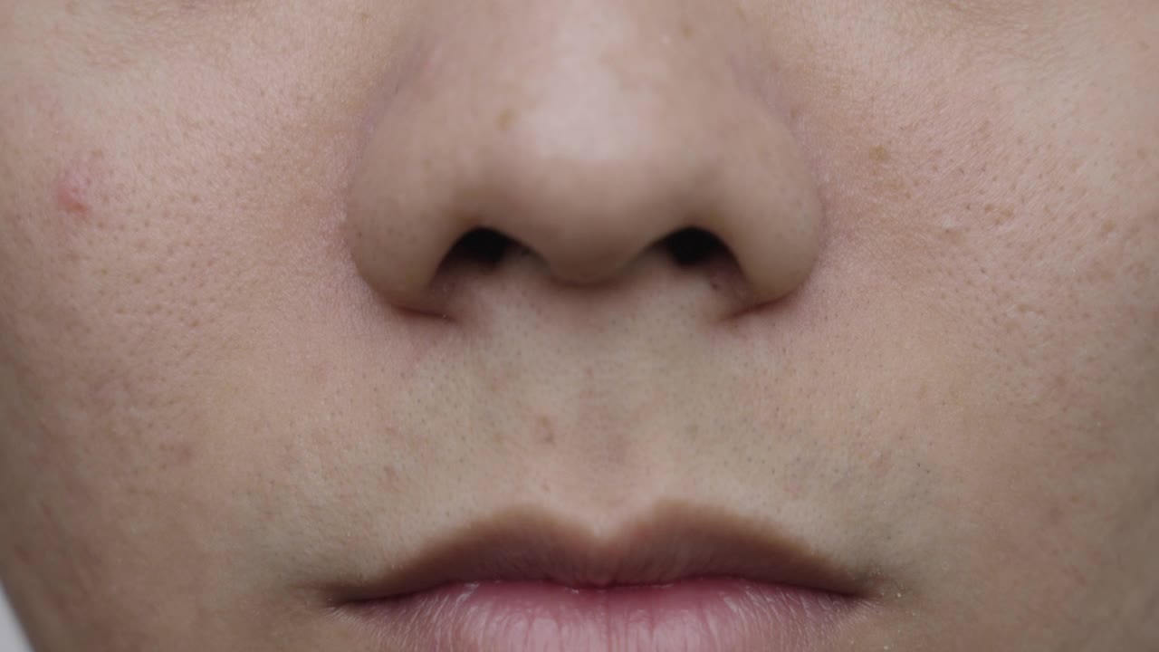 粉刺的鼻子上视频素材