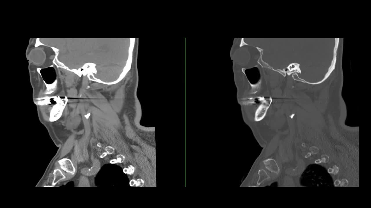 CT颈椎或颈椎矢状面。视频素材