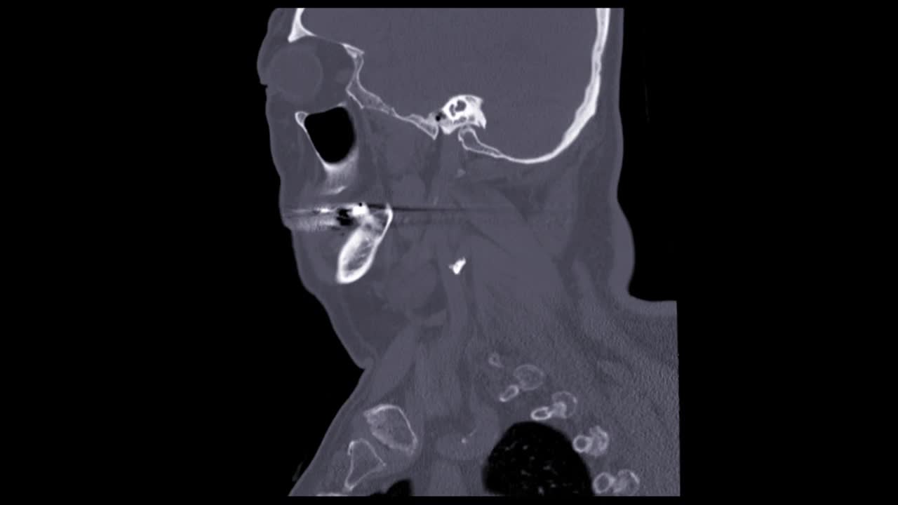 CT颈椎或颈椎矢状面。视频素材