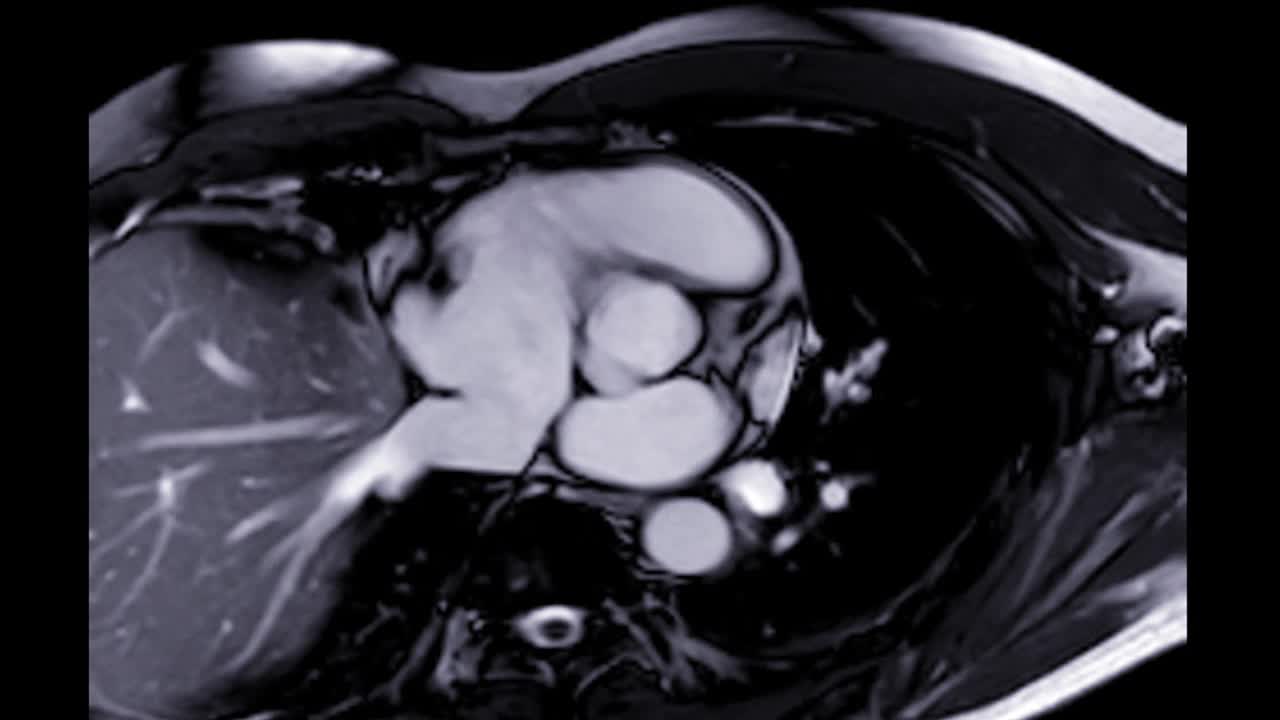 心脏或心脏冠状面MRI(磁共振成像)显示心脏的4个心室工作，用于诊断心脏病。视频素材