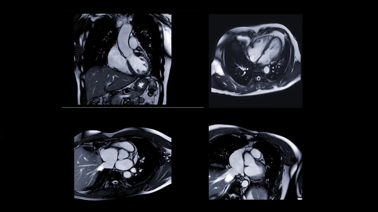 心脏MRI或心脏MRI(磁共振成像)在多视点显示心脏的4室工作，以诊断心脏病。视频素材