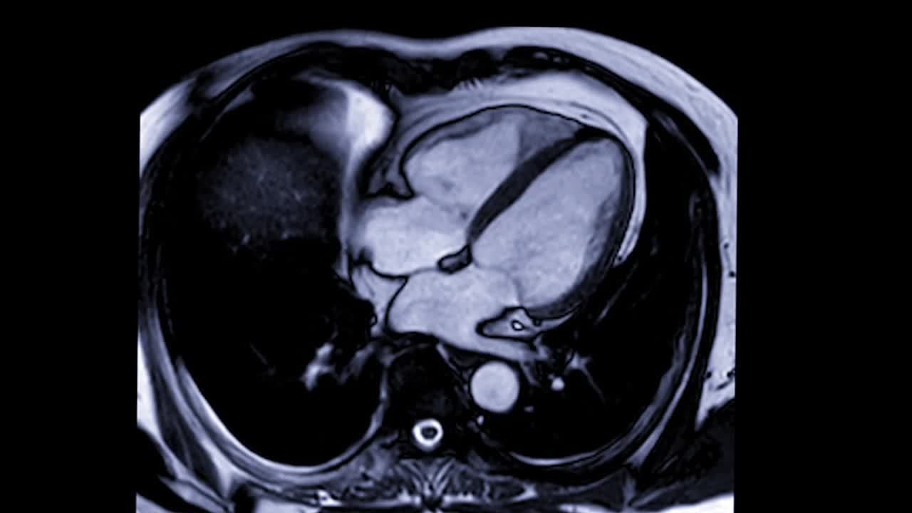 心脏或心脏MRI(磁共振成像)的心脏长轴视图显示心脏跳动，以检测心脏病。视频素材