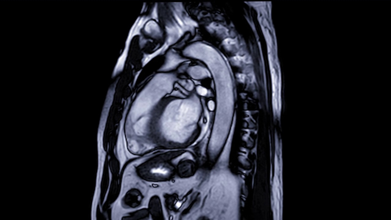 心脏或心脏的MRI(磁共振成像)在矢状面显示心脏跳动，以检测心脏病。视频素材