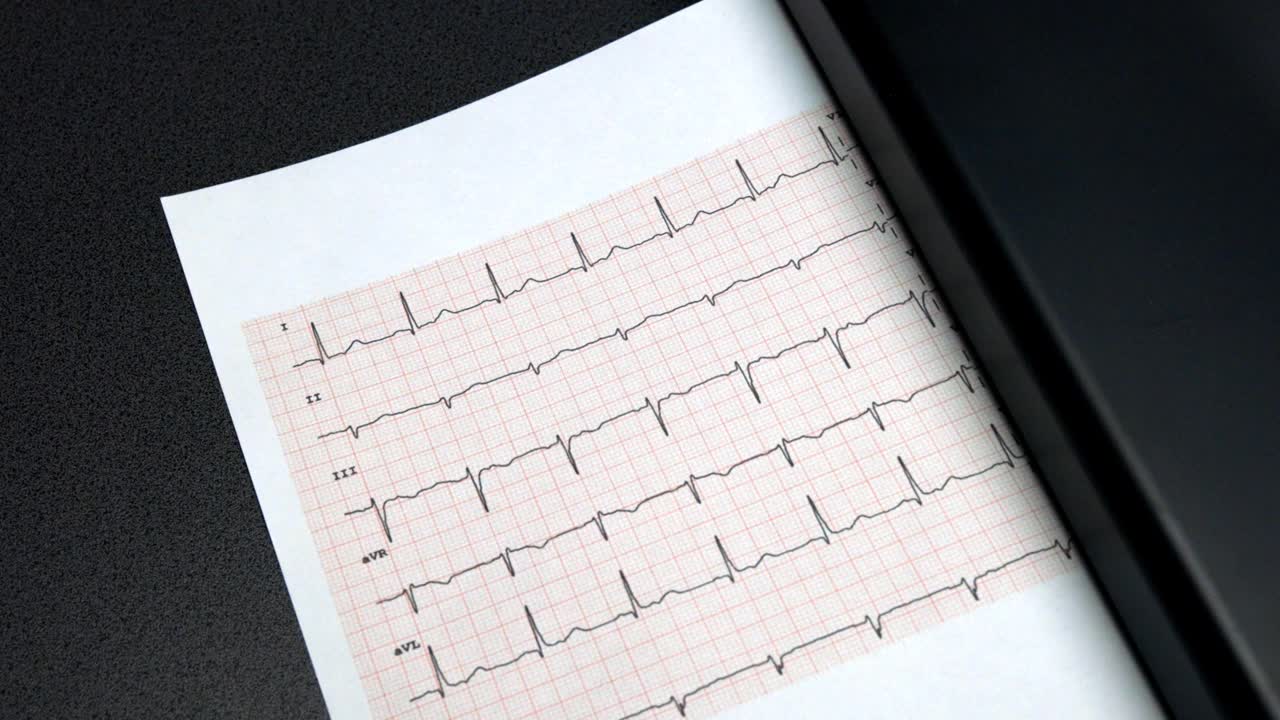 心电图12导联正常窦性心律，心电图打印视频下载