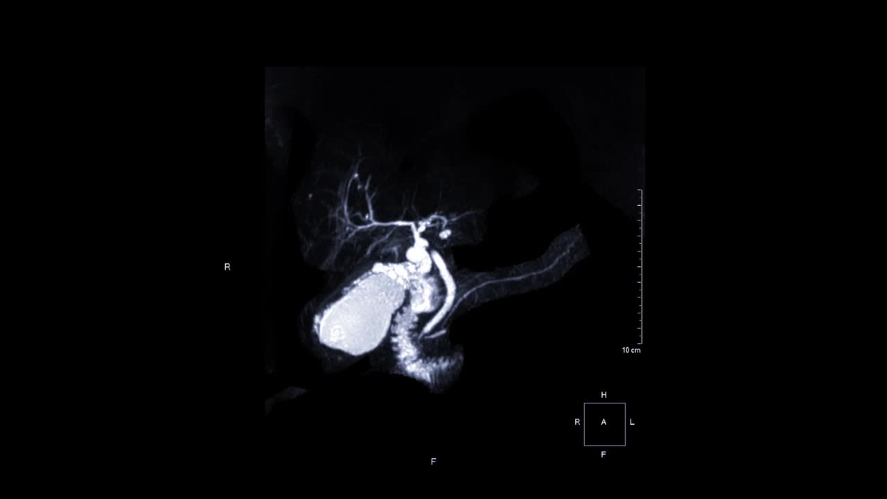 MRCP或磁共振胰胆管造影3D MIP视图显示胆道和胰管的可视化。视频素材