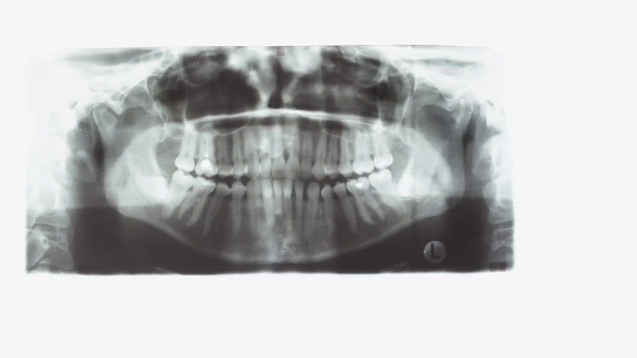 用手指出牙科扫描中有问题的地方。臼齿位置异常。医生以光幕或底片为背景检查x光片视频素材