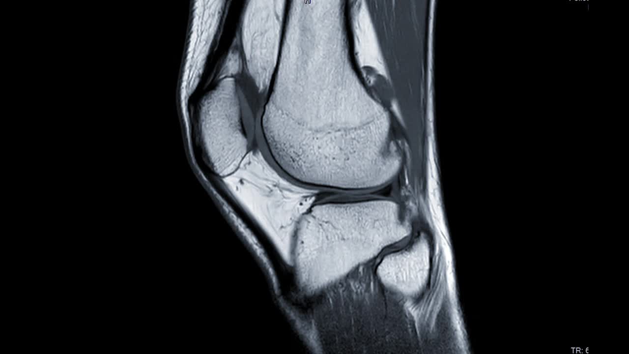 MRI膝关节或MRI膝关节矢状位PDW诊断前交叉韧带撕裂视频素材
