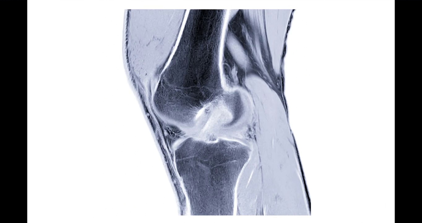 MRI膝关节或磁共振膝关节矢状面成像诊断前交叉韧带撕裂。视频素材