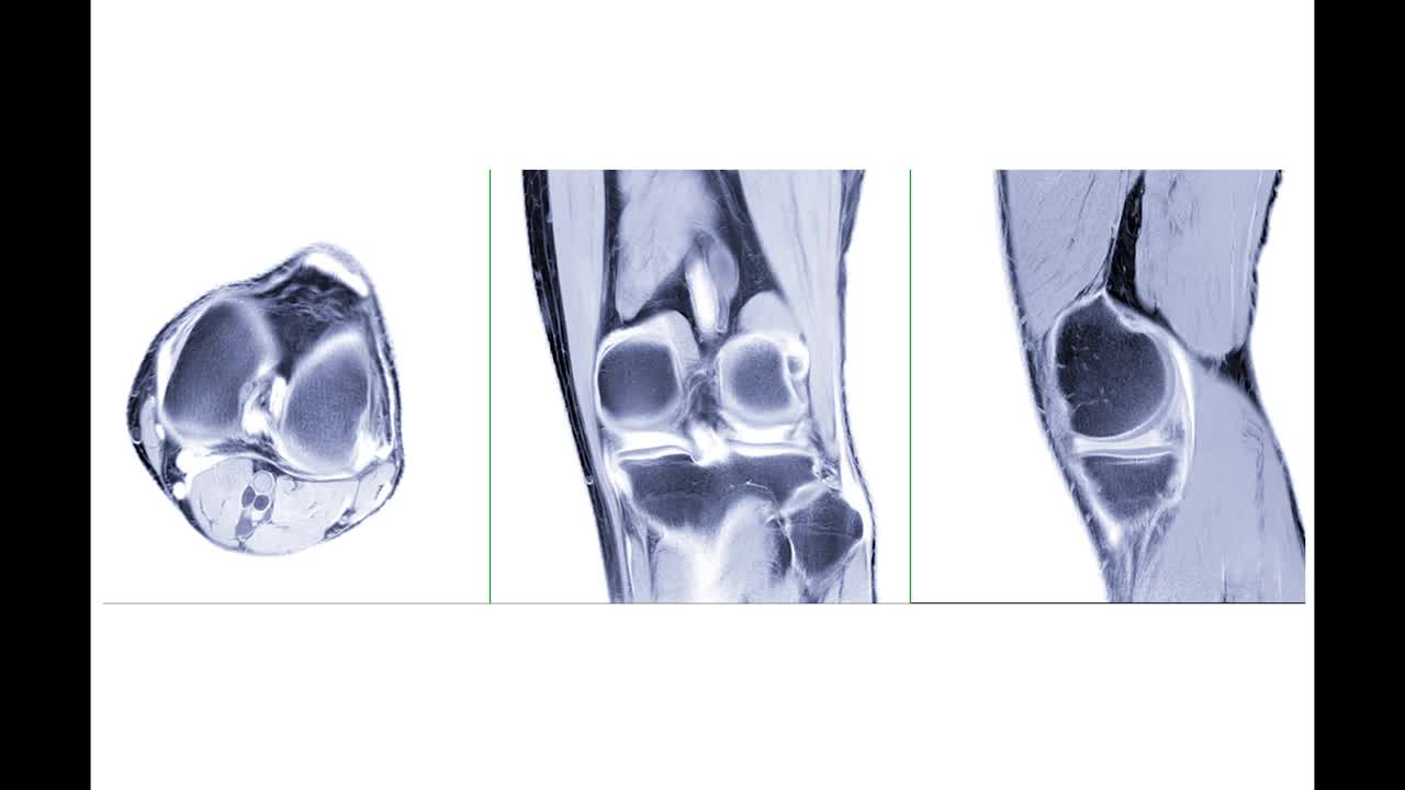 对比MRI膝关节或MRI膝关节轴位、冠状位、矢状位白底对诊断前交叉韧带撕裂的诊断价值。视频素材