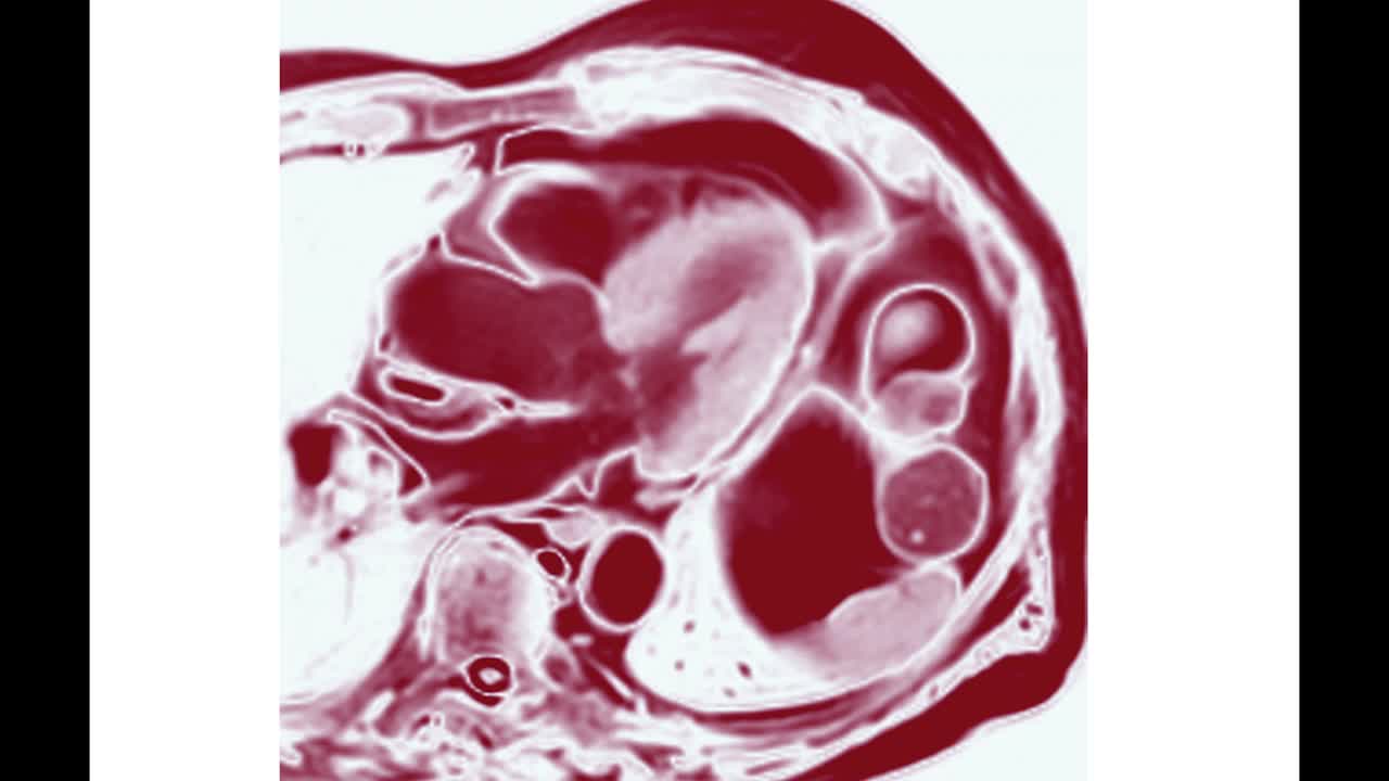 心脏MRI或心脏MRI(心脏磁共振成像)显示心脏跳动，以检测心脏病。视频素材