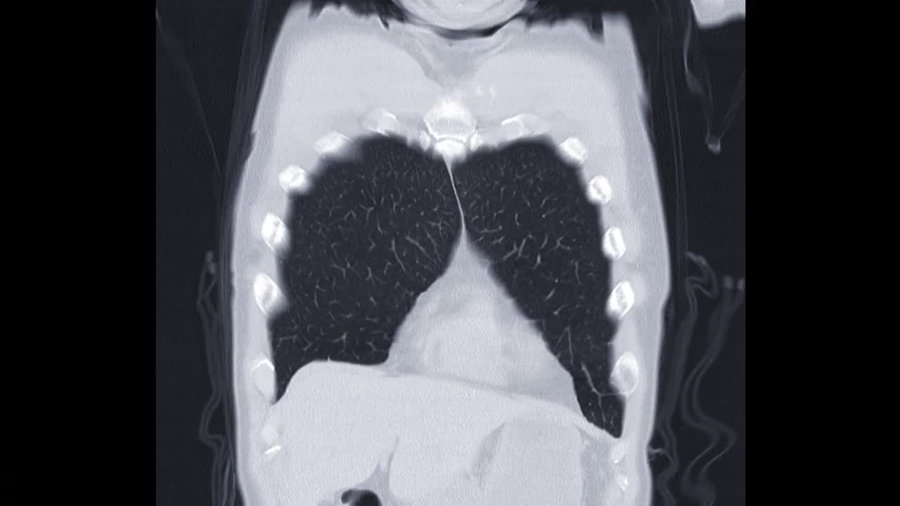 CT胸部或肺部冠状位MIP平扫诊断结核病、结核病和冠状病毒或covid-19。视频素材