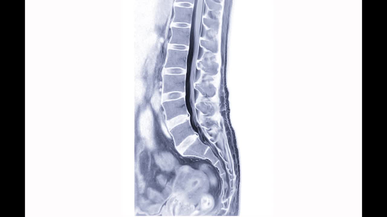 矢状面MRI L-S脊柱或腰椎诊断脊髓受压。视频素材