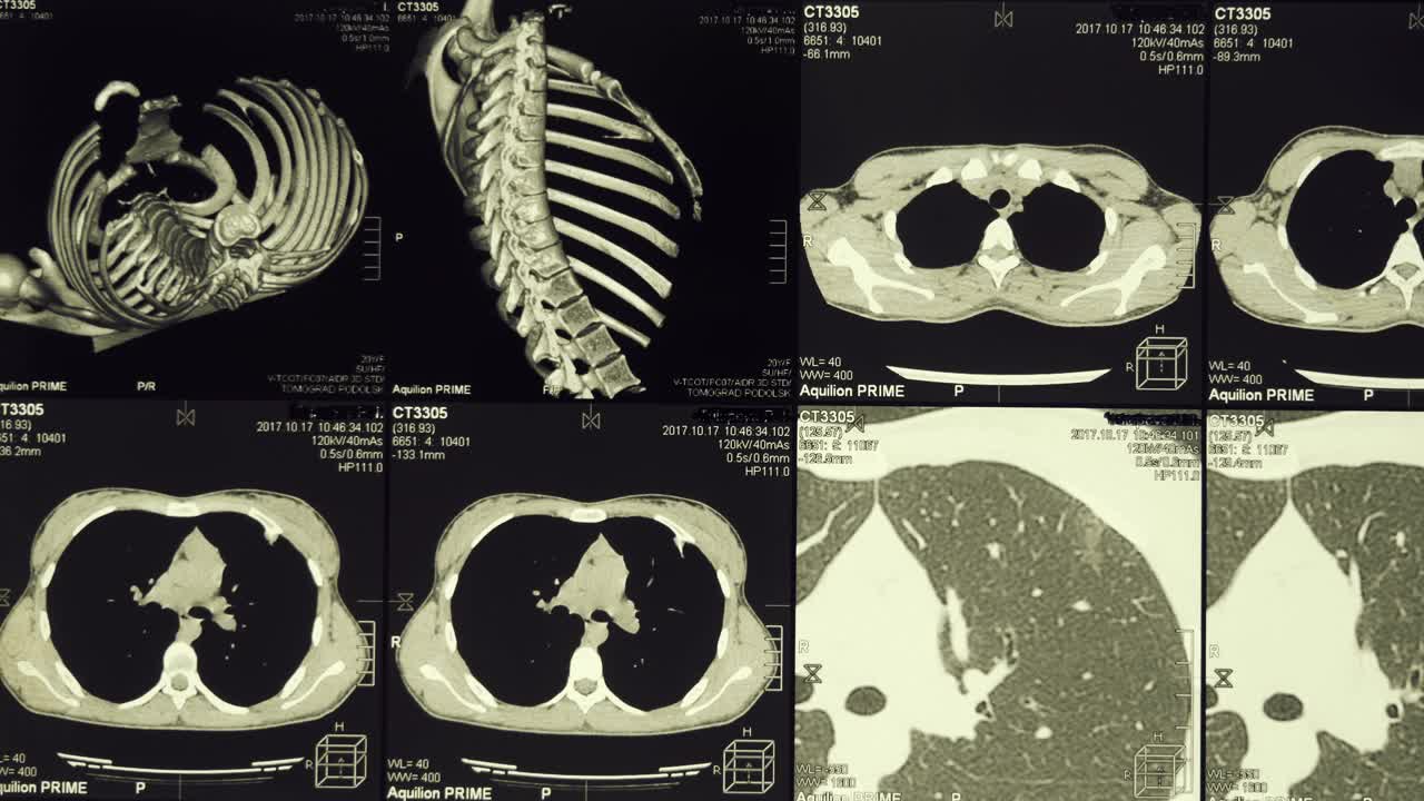 人类胸部与肋骨、脊柱和肺的磁共振成像(MRI)视频素材