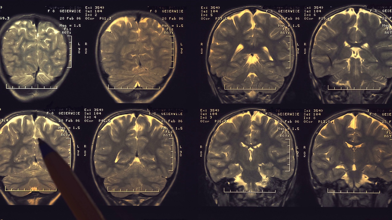 人脑的核磁共振成像(mri)。特写镜头。宏视频素材