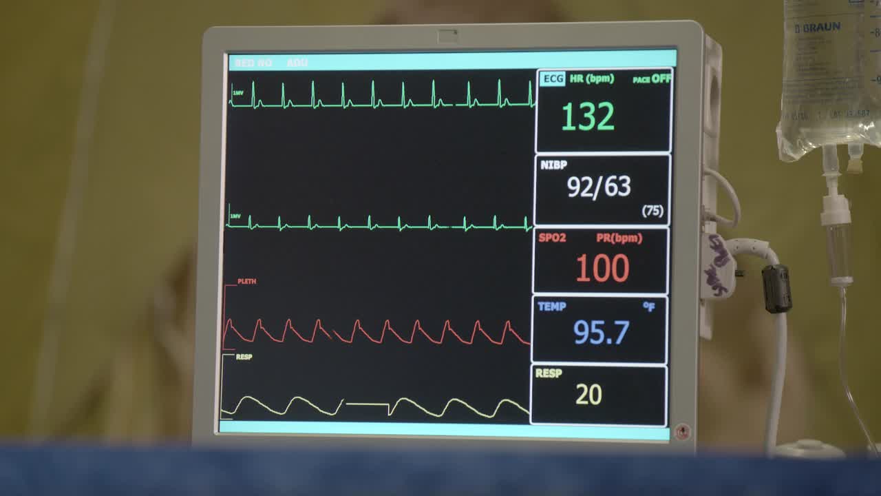 从数字心电图机或心电图机或监护仪到医院或急诊室的呼吸机数字显示器或监护仪的右至左封闭角度。可见静脉袋和点滴管。视频素材