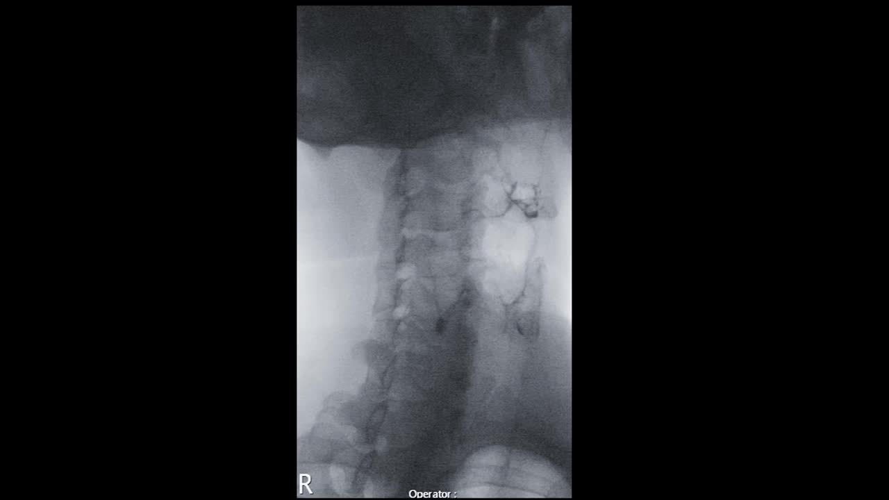 透视下钡餐显示会厌解剖以诊断胃食管溃疡系列或食道癌的吞咽困难。视频素材