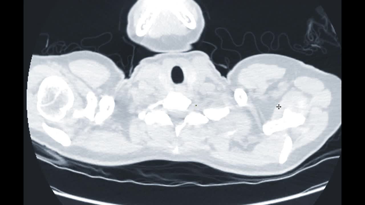 CT胸部或CT肺轴位平，用于诊断肺部疾病和covid-19。视频素材