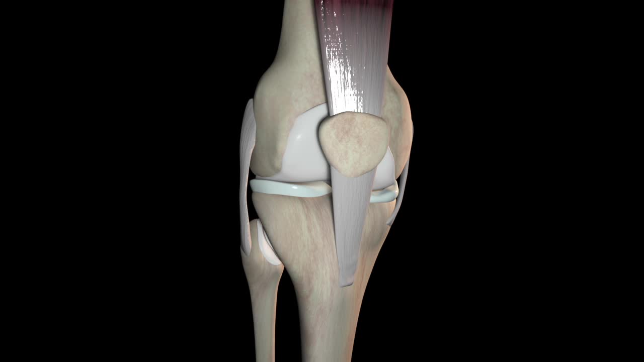 横向移位髌骨骨折视频素材