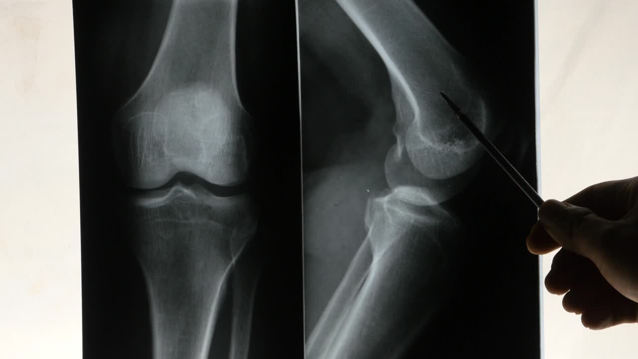 4千名医生研究手臂、腿部关节的x光片进行分析。医疗卫生医院视频素材