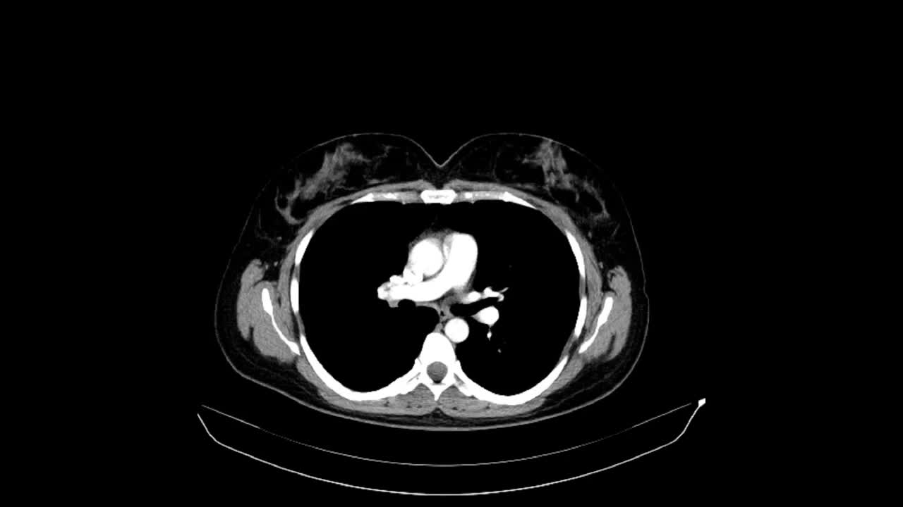 腹部和骨盆的CT及静脉造影，40岁女性。轴向视图。动脉期。视频素材
