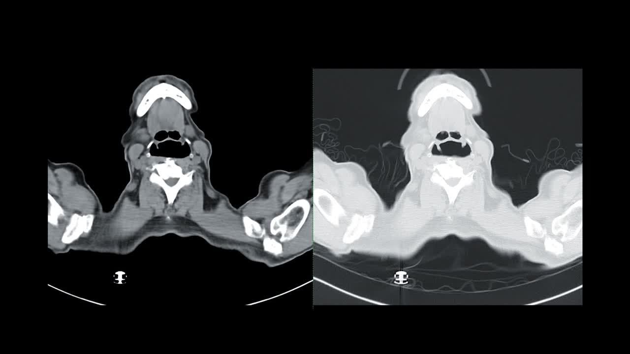 CT胸部或CT肺轴位图软组织和肺窗对诊断肺部疾病和covid-19的比较视频素材