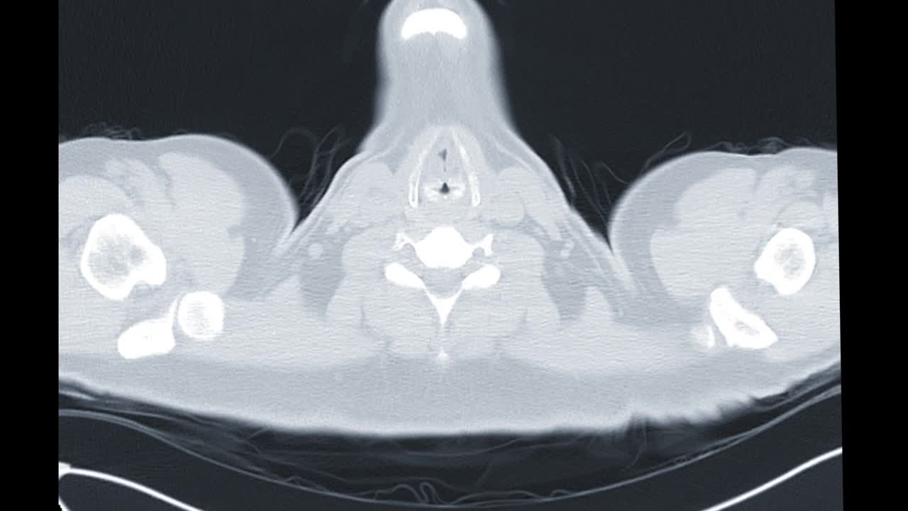 CT胸部或CT肺轴位mip平片用于诊断肺部疾病和covid-19。视频素材