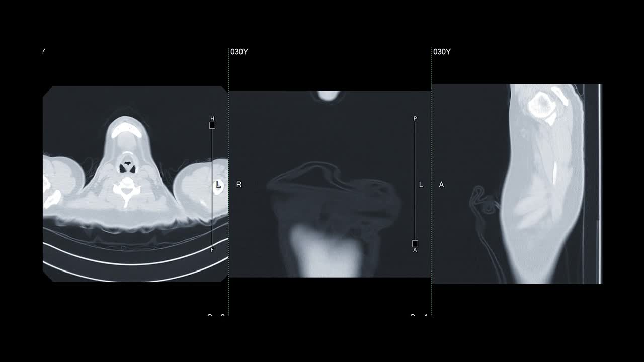 收集CT胸部或CT肺轴位、冠状位和矢状位，用于诊断肺部疾病和covid-19。视频素材