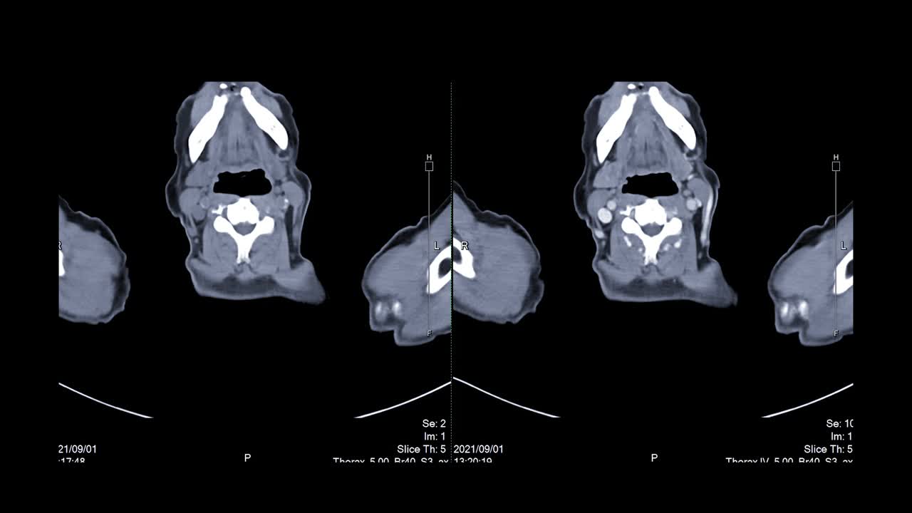 CT胸部或CT肺轴位无造影剂和注射造影剂对诊断肺部疾病和covid-19的比较视频素材