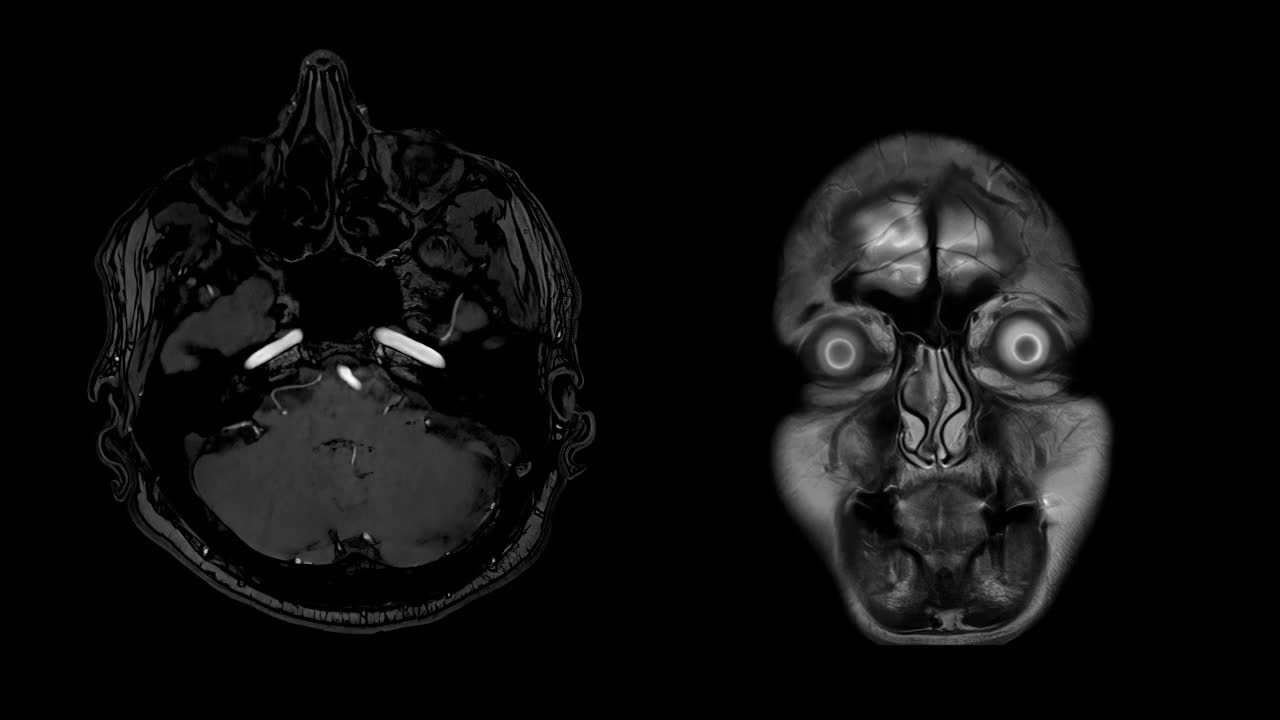 CT脑部核磁共振成像(MRI)视频素材