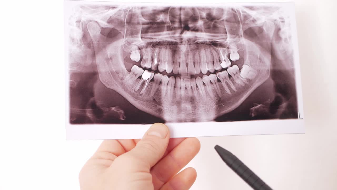 牙科诊所用医用x光检查牙齿有牙冠，补牙，口腔问题。治疗，牙齿脱落，恶化，老化。洞的牙齿。医生指出有问题的地方视频素材